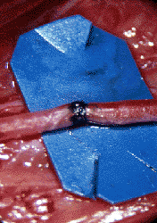 laser-welded vein